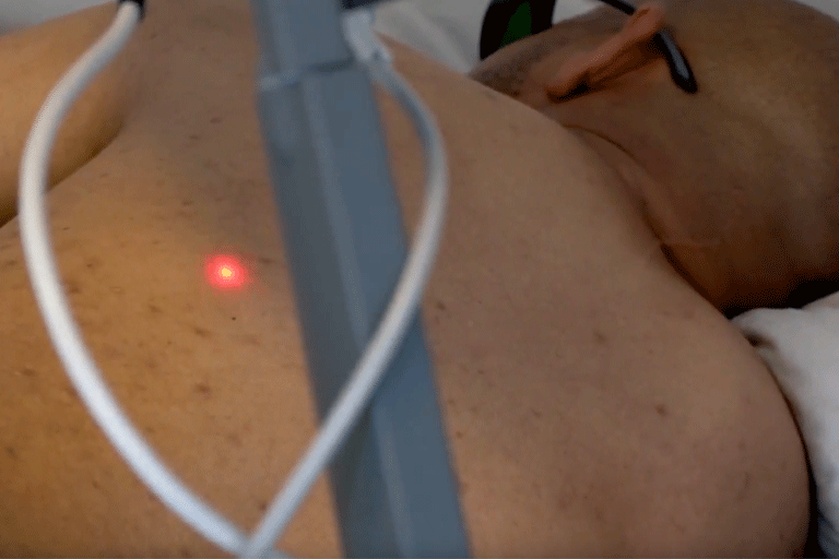 Laser therapy