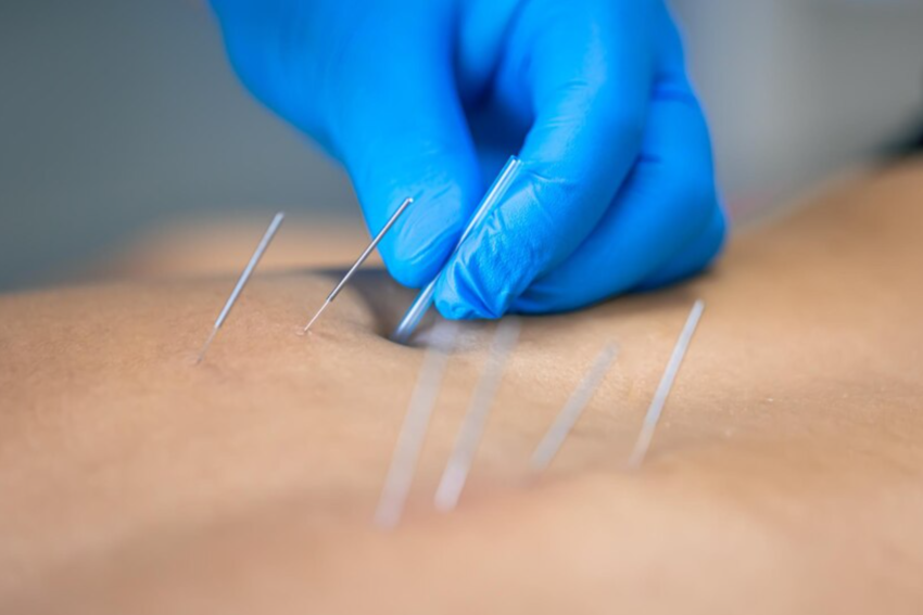 Dry needling